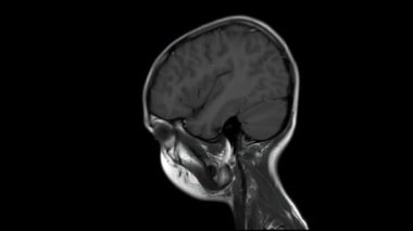 Manyetik rezonans görüntüleme (MRI) 10 yıllık sağlıklı bir çocuk eksenli T2W görüntüleme, döngü