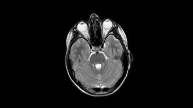 Manyetik rezonans görüntüleme (MRI) 10 yıllık sağlıklı bir çocuk eksenli T2W görüntüleme, döngü