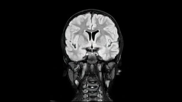 Kernspintomographie Des Gehirns Eines Gesunden Jährigen Jungen Von Vorne Nach — Stockvideo