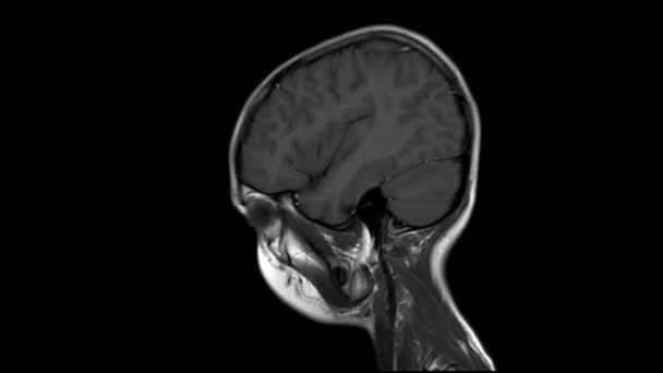 Rezonans Magnetyczny Mri Skan Mózgu Zdrowego Letniego Chłopca Osiowego T2W — Wideo stockowe