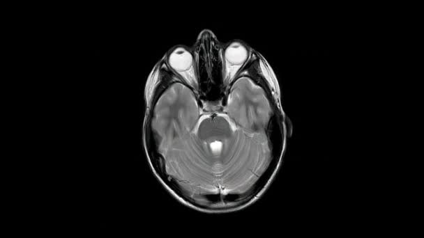 Магнітно Резонансна Томографія Мрт Сканування Мозку Здорового Річного Хлопчика Осьового — стокове відео