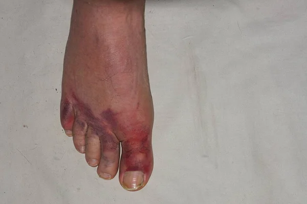 Крупный План Сильно Ушибленных Пальцев Ноге Человека После Падения — стоковое фото