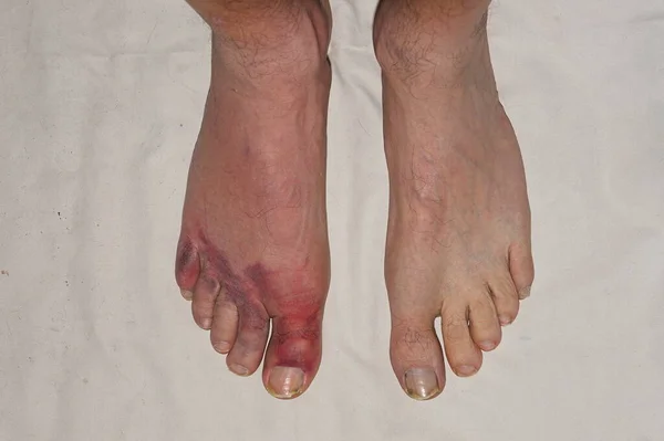 Yaralı Şişmiş Ayak Parmakları Bir Adamın Sağ Ayağında Yaralanmamış Bir — Stok fotoğraf