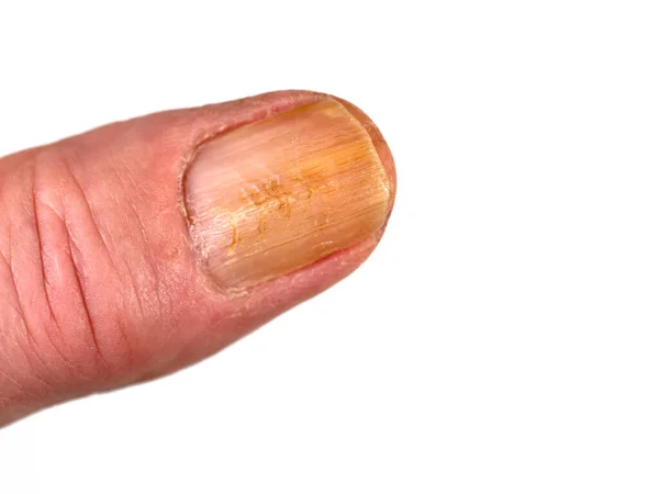 stock image Fingernail with nail fungus against white background