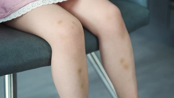小さな女の子の足に傷のしみの傷を閉じます 抽出青 皮膚上の紫 子供時代のコンセプト 高品質4K映像 — ストック動画