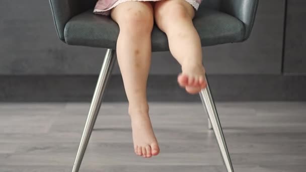 小女孩腿上有淤青伤痕的特写镜头 渗出蓝色 皮肤上有紫色 积极的童年概念 高质量的4K镜头 — 图库视频影像