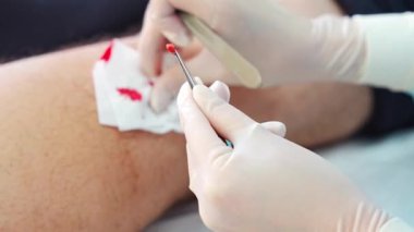 Dermatolog bir cerrah tarafından alınmış bir deri parçası. Ameliyat sürecine yakından bakmak için. Yüksek kalite 4k görüntü