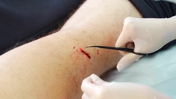 Φρέσκο Τραύμα Ράμματα Μετά Την Εγχείρηση Αφαίρεση Όγκων Δέρματος Υψηλής — Αρχείο Βίντεο
