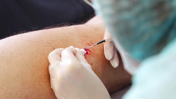 Dermatóloga Mujer Cirujano Elimina Las Enfermedades Piel Con Electrocoagulador Vista — Vídeo de stock