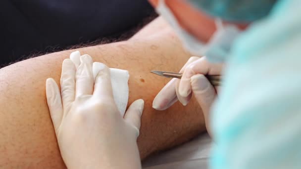 Dermatologo Chirurgo Rimuove Malattie Della Pelle Con Bisturi Processo Operativo — Video Stock