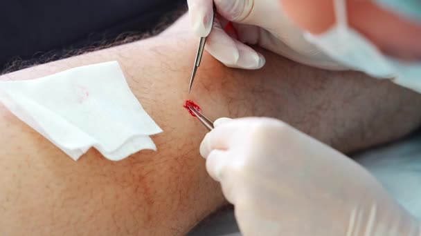 Dermatoloog Chirurg Verwijdert Huidziekten Met Scalpel Pincet Close Zicht Het — Stockvideo