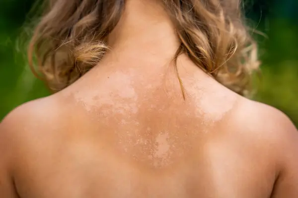 stock image The skin is very peeling after sunbathing, the tanned back of a little girl. Sunburn concept. High quality photo