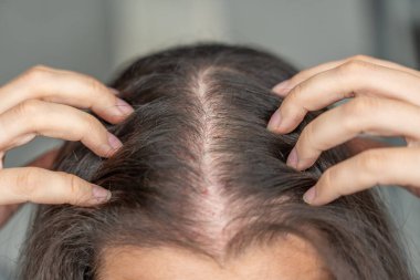 Kafaya yakından bakınca, mesoterapiden sonra yapılan iğnelerden kaynaklanan kan izleri, alopecia konseptinin tedavisi