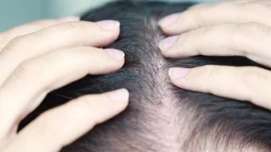 Kafaya yakından bakınca, mesoterapiden sonra yapılan iğnelerden kaynaklanan kan izleri, alopecia konseptinin tedavisi