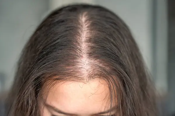 Kafaya yakından bakınca, mesoterapiden sonra yapılan iğnelerden kaynaklanan kan izleri, alopecia konseptinin tedavisi
