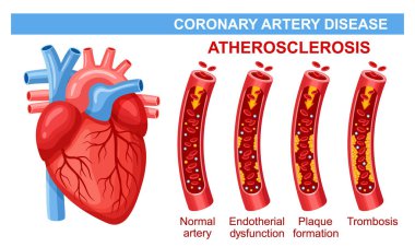 Koroner arter hastalığı, arteriyel atheroskleroz, kalp krizi, kan dolaşımı, damar kolesterolü plağı. Kardiyak kardiyovasküler sistem kardiyoloji hastalığı tedavisi. İnsan kardiyo kası. Damar trombozu. Sağlık hizmetleri vektörü
