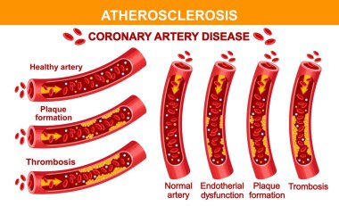 Ateroskleroz koroner damar hastalığı, damar kolesterolü plağı, kan akışı basıncı, kardiyak kardiyovasküler damar trombozu. Kalp sağlığı, yüksek tansiyon. Arterioskleroz hastalığı kardiyoloji tıbbi tedavisi. Vektör