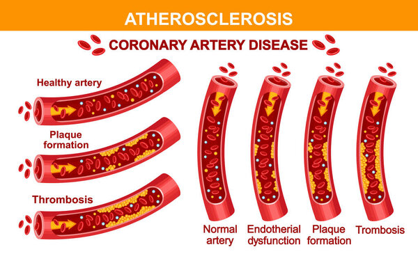 Атеросклероз ишемической болезни сердца, блокада артериального сосуда, холестерина бляшки, кровяного давления, сердечно-сосудистой системы сосудистой тромбоз. Здоровье органов сердца, гипертония. Кардиологическое лечение артериосклероза. Вектор