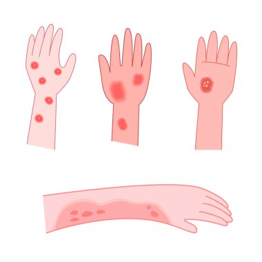 Çizgi romanda illüstrasyon ve tıbbi yardım için kaşıntı var. Alerji konsepti