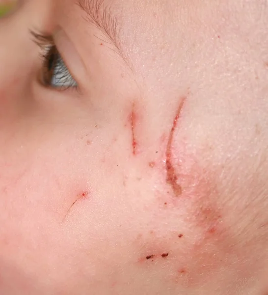 Barnet Kliar Sig Huden Rivmärken Babys Hud Huden Ansiktet Inflammerad — Stockfoto
