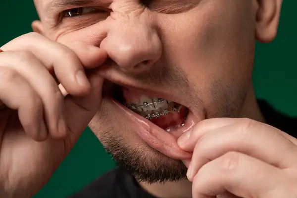 A man with braces on his teeth is shown holding his thumb to his mouth, possibly indicating discomfort or pain. The metal braces are visible on his teeth as he gestures with his hand.
