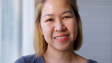 Syringoma milia milium cysts or seborrheic keratosis on asia people female face body care. Close-up young adult asian woman under eye small acne liver spot skin issue smile with pride look at camera.