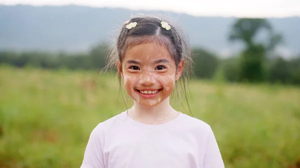 Gadis Kecil Alfa Muda Alfa Vitiligo Yang Lucu Santai Tersenyum — Stok Foto