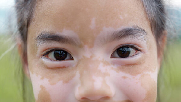 Little Cute Alpha Young Albino Vitiligo Small School Girl Relax Royalty Free Stock Images