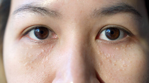 Syringoma Milia Milium Cysts Seborrheic Keratosis Asia People Female Face Royalty Free Stock Images