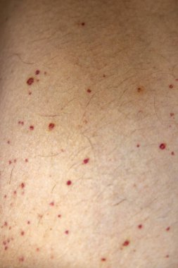 Vaskülit. Bacaklarda vaskülit. Küçük kırmızı ya da mor noktalar. Cesedin bağışıklık reaksiyonuna bağlı ölüm sonrası sendromu. Tahıl. Kan damarlarında iltihap var. Nadir bir hastalık. Fotoğraf:.