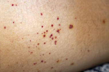Vaskülit. Bacaklarda vaskülit. Küçük kırmızı ya da mor noktalar. Cesedin bağışıklık reaksiyonuna bağlı ölüm sonrası sendromu. Tahıl. Kan damarlarında iltihap var. Nadir bir hastalık. Fotoğraf:.