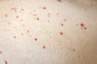 Vaskülit. Bacaklarda vaskülit. Küçük kırmızı ya da mor noktalar. Cesedin bağışıklık reaksiyonuna bağlı ölüm sonrası sendromu. Tahıl. Kan damarlarında iltihap var. Nadir bir hastalık. Fotoğraf:.