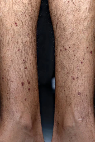 Vasculitis. Vasculitis in legs. Small red or purple spots. Post covid syndrome due to an immunological reaction of the body. Grain. Inflammation of the blood vessels. Rare disease. Photography.