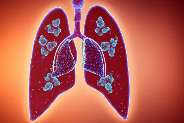 stock image Lungs. Pertussis. Whooping cough. Bordetella pertussis. Lungs with bacteria. Design of lungs with bacteria inside the lungs representing a lung disease.