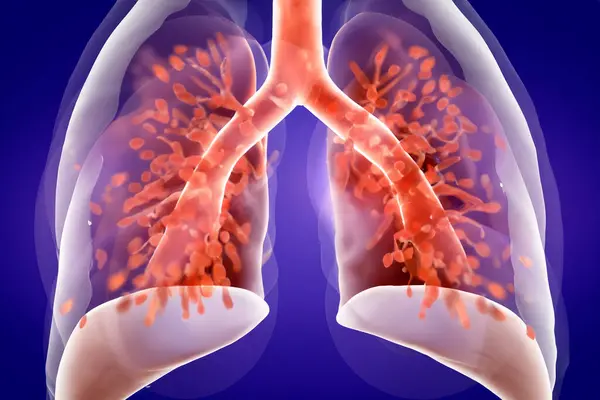 stock image Lungs. Pertussis. Whooping cough. Bordetella pertussis. Lungs with bacteria. Design of lungs with bacteria inside the lungs representing a lung disease.
