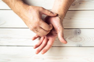 Sedef hastalığından muzdarip tanınmayan bir adamın üst görüntüsü iltihaplı kaşıntılar, beyaz ahşap arka planda parmakları olan palmiye derisinde pullu döküntüler. Sağlık, otoimmün genetik hastalıklar, cilt bakımı.