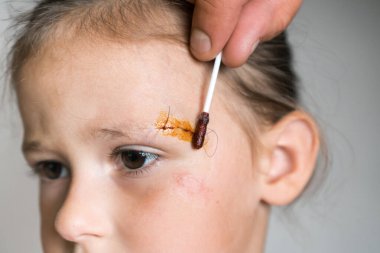 Üzgün, sabırlı kız yüzünü kırpılmış erkek eli ile kapat, başındaki dikişlere iyot sür. Çocuklar fiziksel yaralar ve aile istismarı. Temiz yara, yara..