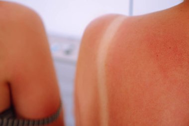 Kırpılmış güneş yanığı kadın omuzları ve beyaz mayo kayışı. Korunmaya, güneş kremine ya da sağlıklı cilt kremine ihtiyacım var. Acı verici durum ve kanser riski, morötesi etkiye maruz kalma
