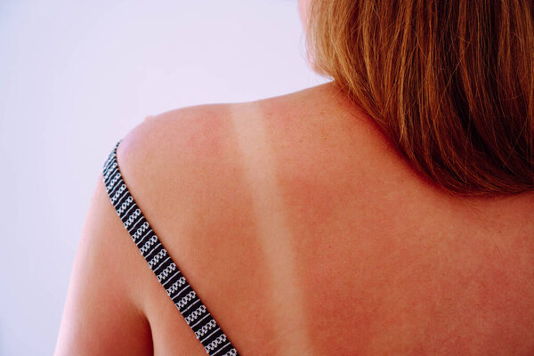Unrecognizable person shows an unburned strip on back from straps of swimsuit. Healthy clean skin. Sun protection products. Skin care. Recreation and travel. Sun tan. Beauty and health.