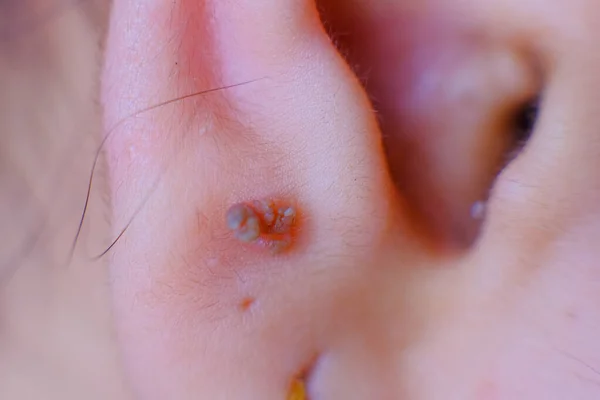 少女の耳元にある皮膚のむち打ちの写真です — ストック写真