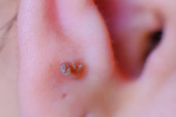 Closeup Photo Skin Warts Earlobe Girl — Stock Photo, Image