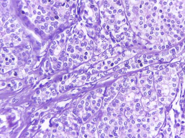 Mor Lekeli Hücre Yapılarının Mikroskobik Görünümü