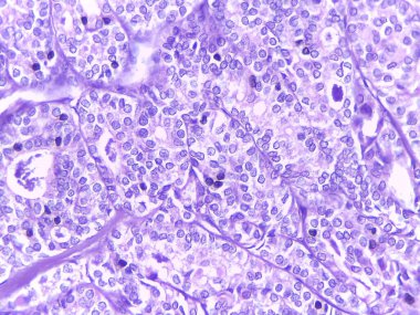 Mor Lekeli Mikroskobik Doku Analizi