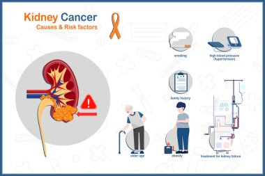 Böbrek kanserinin tıbbi vektör çizimi kavramı. Böbrek kanserinin nedenleri ve risk faktörleri, yaşlılık, sigara, obezite, yüksek tansiyon, aile geçmişi, böbrek kanseri tedavisi, böbrek yetmezliği