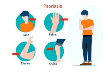 Sağlık hizmetleri konseptinin düz çizimi. Dirsekler, dizler, yüz ve avuçlar gibi sedef hastalığından etkilenen vücut parçaları.