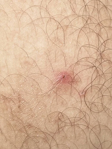 Fechar Cicatriz Pele Corpo — Fotografia de Stock