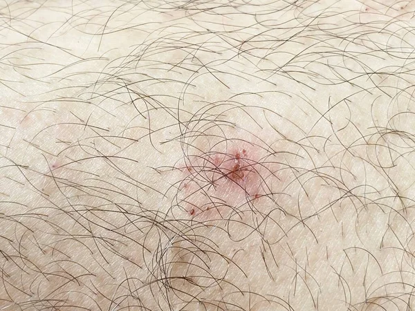 Fechar Cicatriz Pele — Fotografia de Stock
