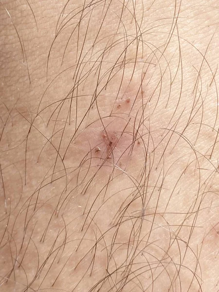 Cicatrice Vicino Sulla Pelle — Foto Stock