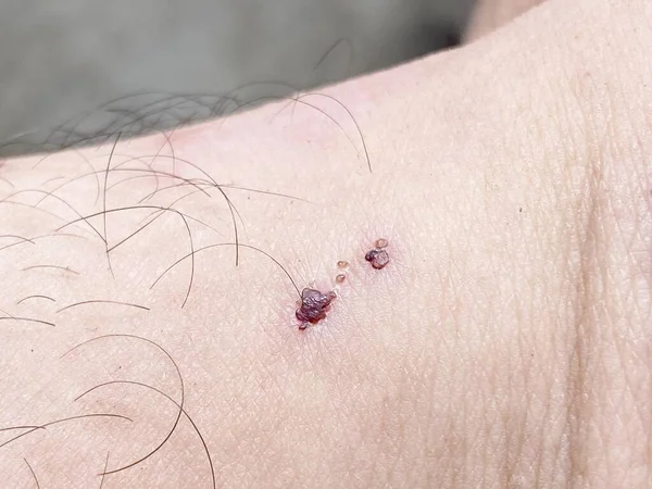 close up scar on skin