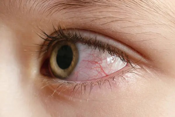 Ojos Rojos Infectados Irritados Primer Plano Conjuntivitis Imagen De Stock